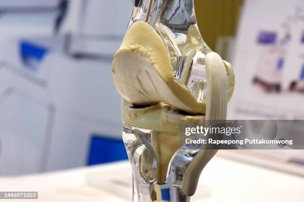 a model of a total knee replacement - prosthetic equipment stock pictures, royalty-free photos & images