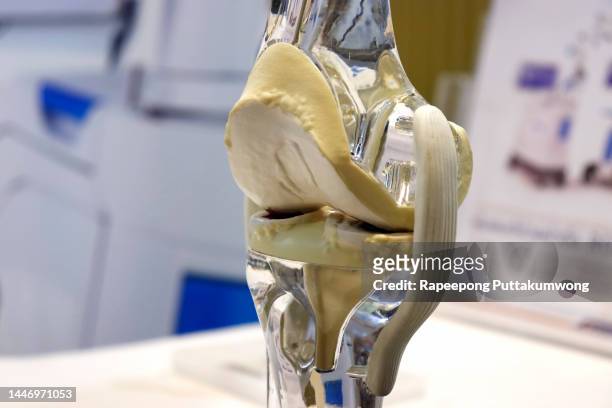 a model of a total knee replacement - knee replacement surgery - fotografias e filmes do acervo