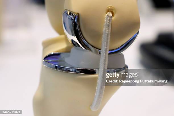 knee joint replacement - knee replacement surgery foto e immagini stock