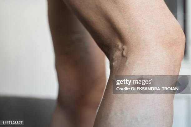 close-up of varicose veins on woman leg - varicose vein stock pictures, royalty-free photos & images