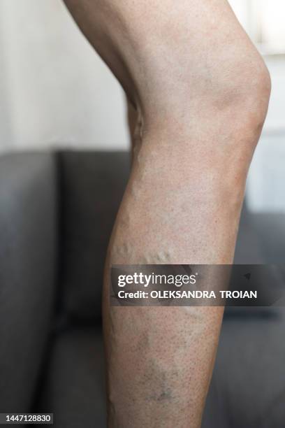 close-up of varicose veins on woman leg - bloody leg stock pictures, royalty-free photos & images