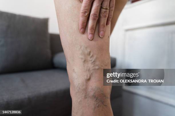 close-up of varicose veins on woman leg - beauty treatment stockfoto's en -beelden