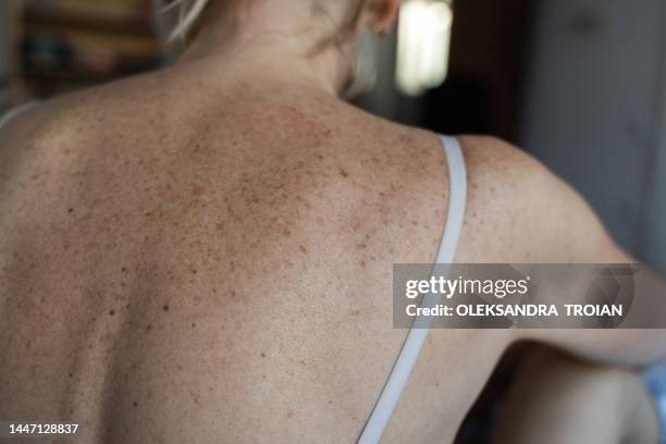 close up of mature woman skin with hyperpigmentation - hyperpigmentation stock pictures, royalty-free photos & images
