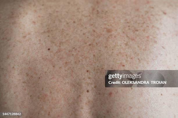 close up of mature woman skin with hyperpigmentation - complexion stock-fotos und bilder