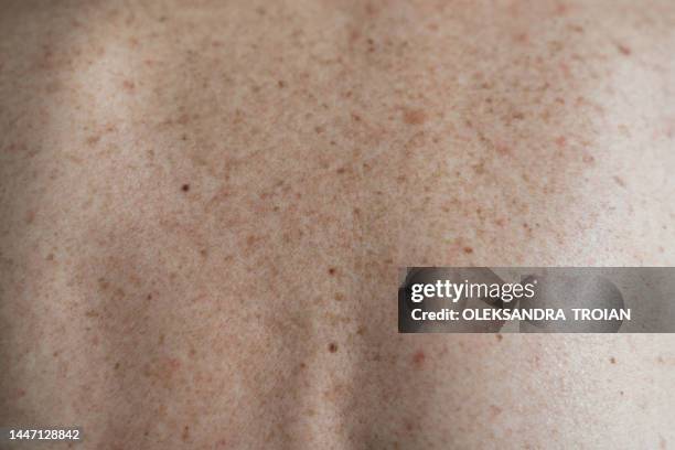 close up of mature woman skin with hyperpigmentation - enveloppe photos et images de collection