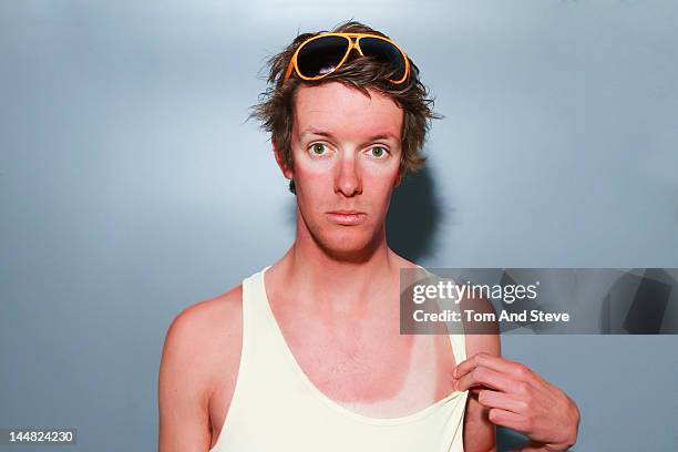 a sunburnt man with tanlines - sunburn stock-fotos und bilder