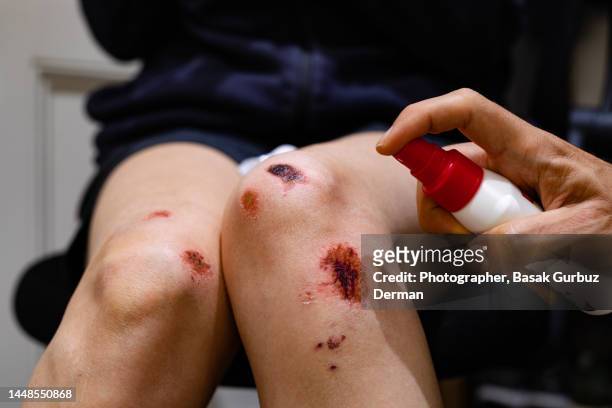 doctor applying an antiseptic spray on a bruised / injured / wounded knee - women sport injury imagens e fotografias de stock