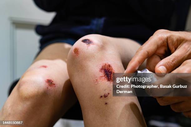doctor applying an antibiotic topical cream on a bruised / injured / wounded knee - bloody leg stock pictures, royalty-free photos & images