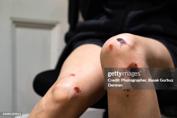 close-up of bruised / injured / wounded knee - queimadura pele - fotografias e filmes do acervo