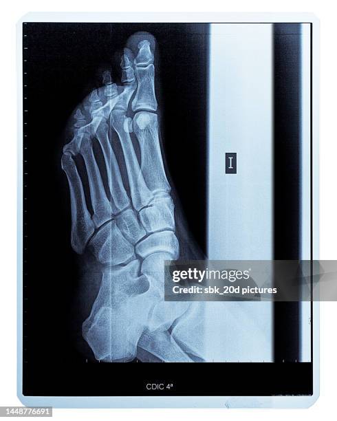 Hi Resolution Toes Toe X Ray Photos and Premium High Res Pictures - Getty Images