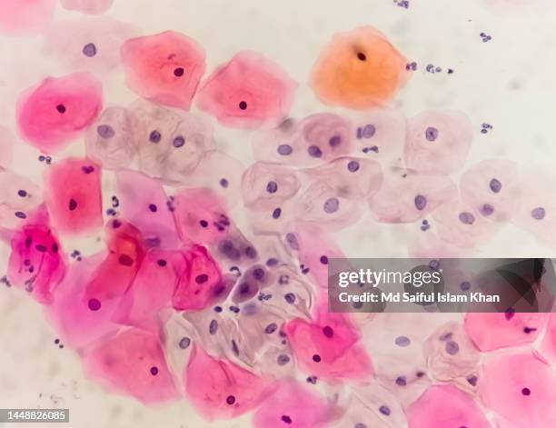 Paps smear under microscopy showing inflammatory smear with hpv related changes. Cervical cancer. SCC