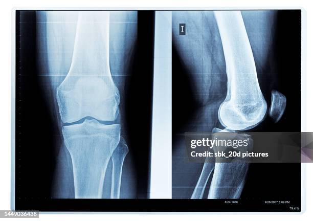 x-ray knee 04 - femur fotografías e imágenes de stock