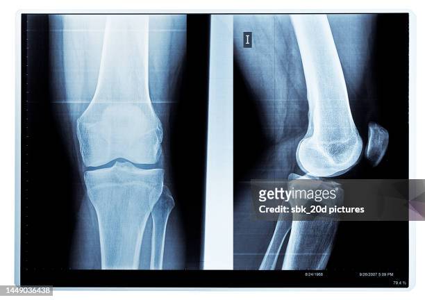 x-ray knee 04 - imagerie par rayons x photos et images de collection