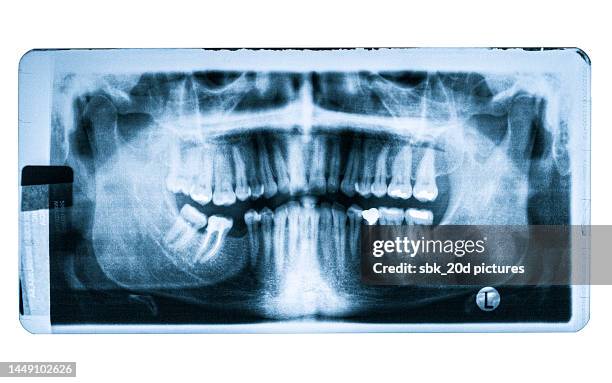 x-ray mouth - röntgenaufnahme stock-fotos und bilder
