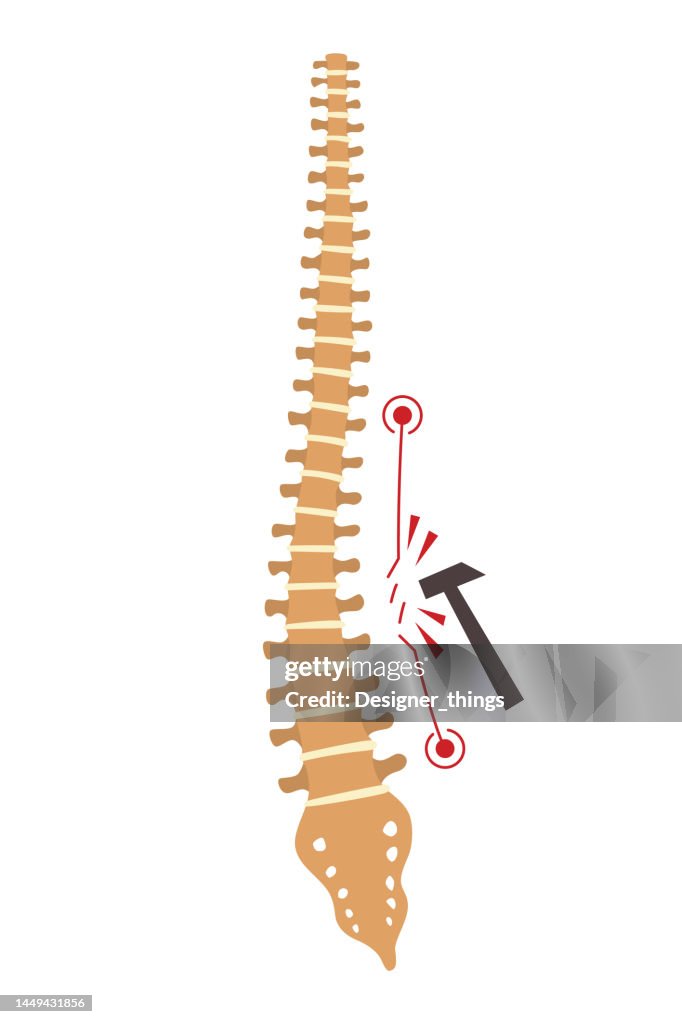 Spinal Defet Spinal Deformity Symbol Of Spine Curvatures Or Unhealthy Backbones ...