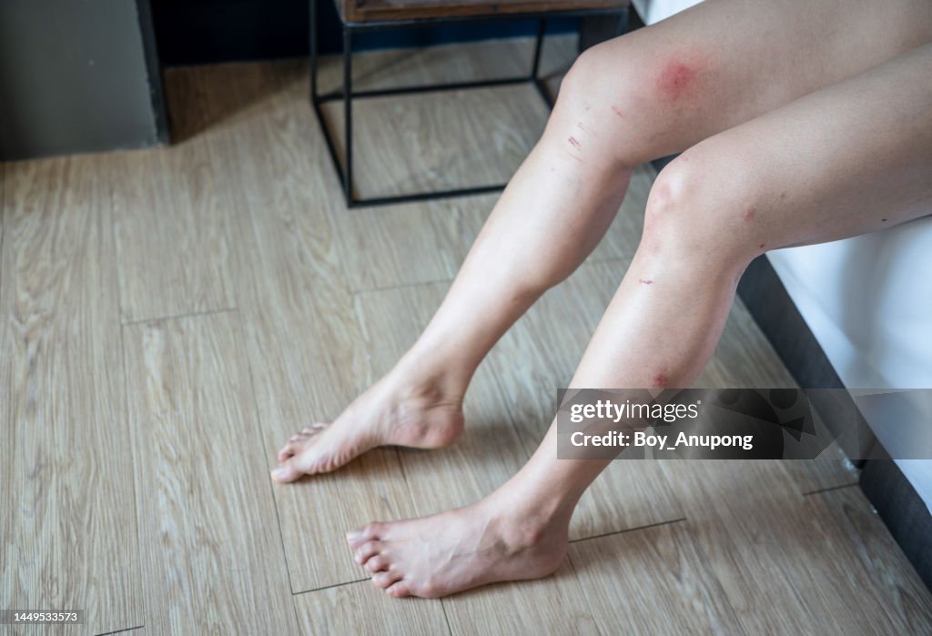 Cropped shot of woman having scar and scratched on her leg caused of accident or injury.