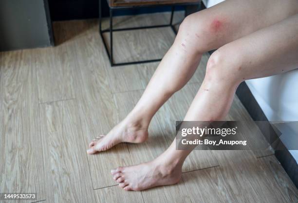 cropped shot of woman having scar and scratched on her leg caused of accident or injury. - woman holding legs fotografías e imágenes de stock