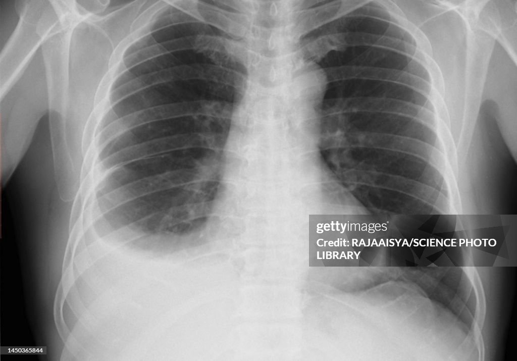 Pleural effusion, X-ray