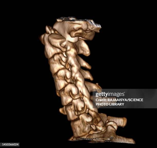 dislocated neck bones, 3d ct scan - dislocation stock pictures, royalty-free photos & images