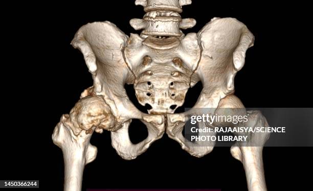 osteoarthritis of the hip, 3d ct scan - hip stock pictures, royalty-free photos & images