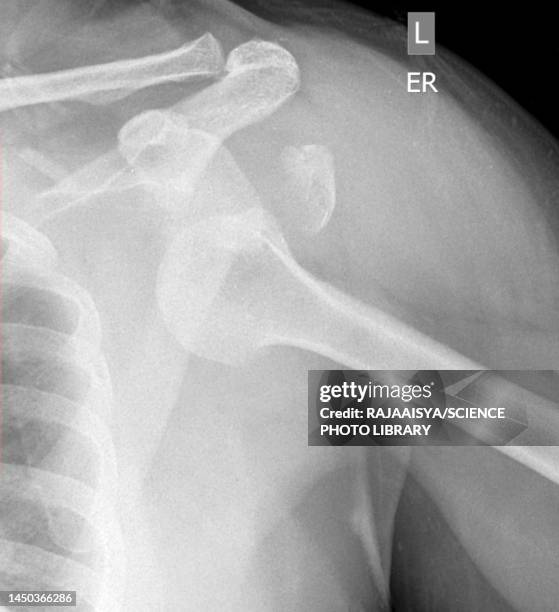 dislocated shoulder, x-ray - verrenkung stock-fotos und bilder