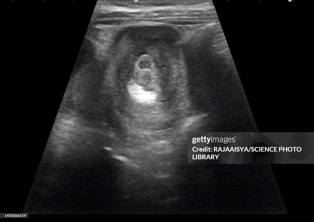 Intussusception Of The Intestines Ultrasound Scan Foto de stock - Getty ...
