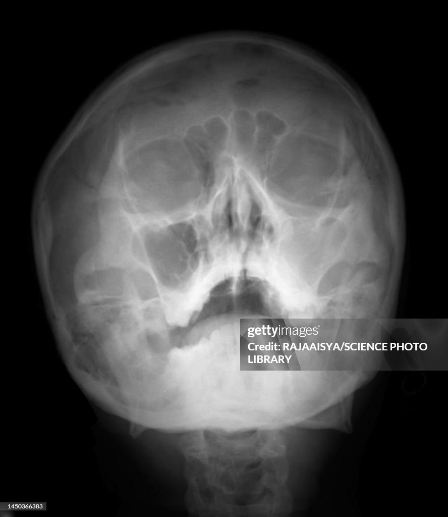 Sinusitis Xray High-Res Stock Photo - Getty Images
