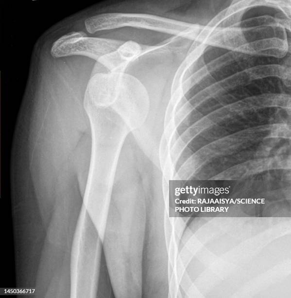 dislocated shoulder, x-ray - verrenkung stock-fotos und bilder