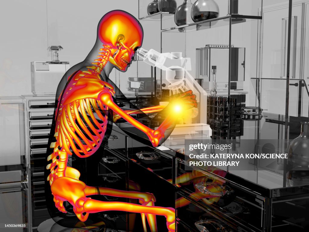 Carpal tunnel syndrome in laboratory workers, illustration