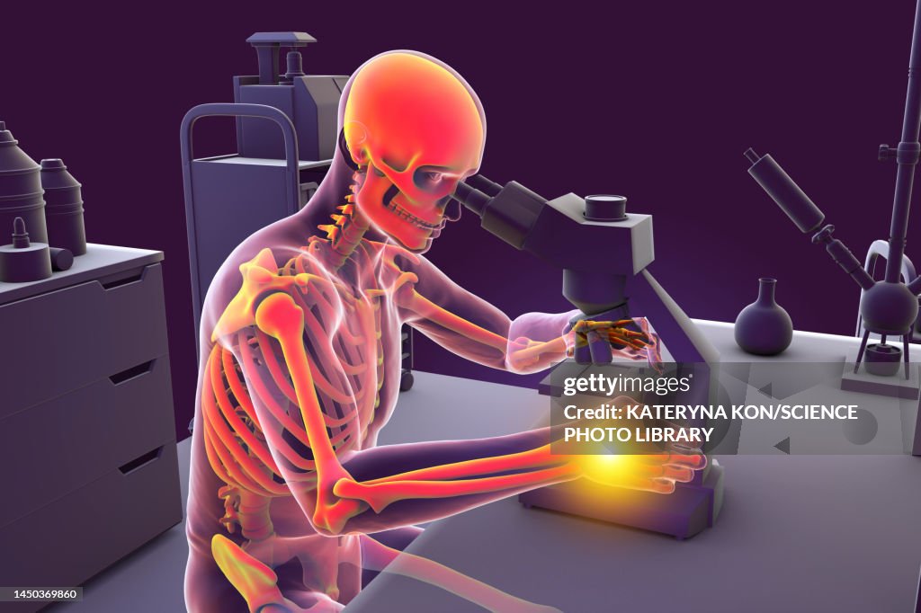 Carpal tunnel syndrome in laboratory workers, illustration