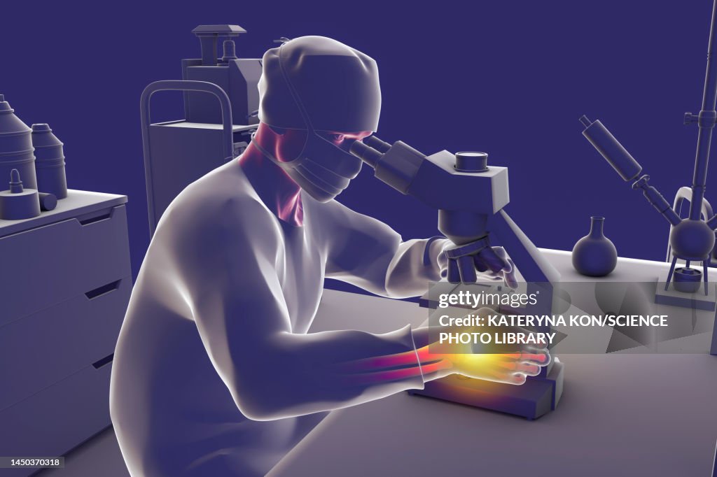 Carpal tunnel syndrome in laboratory workers, illustration