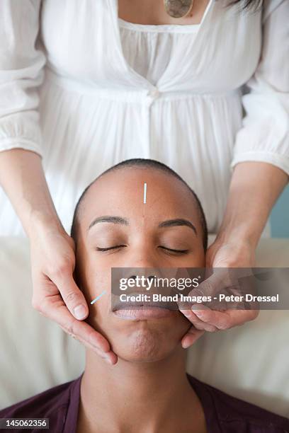 black woman receiving acupuncture treatments - acupuncture photos et images de collection