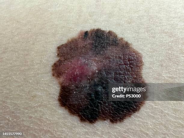 Iovance sees long-term response for Amtagvi in first-line melanoma ...