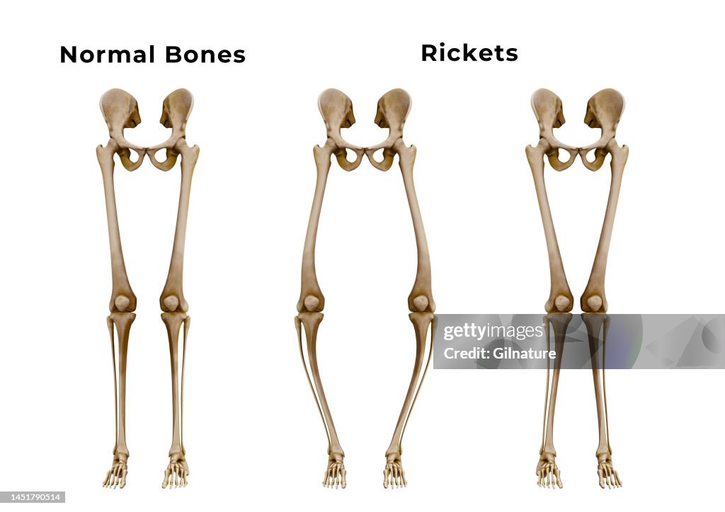 Cartilidge Rickets Skeletal Disorder Arthritis Rickets Bone Diseases Anatomy Reading ...