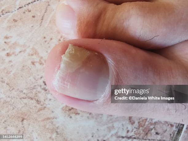 fungal nail infection - toenail stock pictures, royalty-free photos & images
