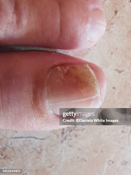 fungal nail infection - foot fungus stock pictures, royalty-free photos & images