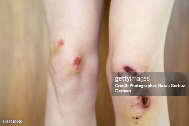 skin graze on the knee. - scraped knee stock pictures, royalty-free photos & images