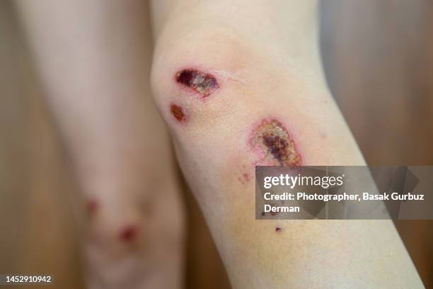 skin graze on the knee. - infected wound stock-fotos und bilder