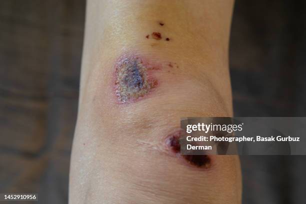 skin graze on the knee. - scraped knee stock pictures, royalty-free photos & images