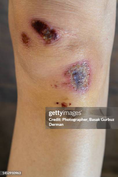 skin graze on the knee. - scraped knee stock pictures, royalty-free photos & images