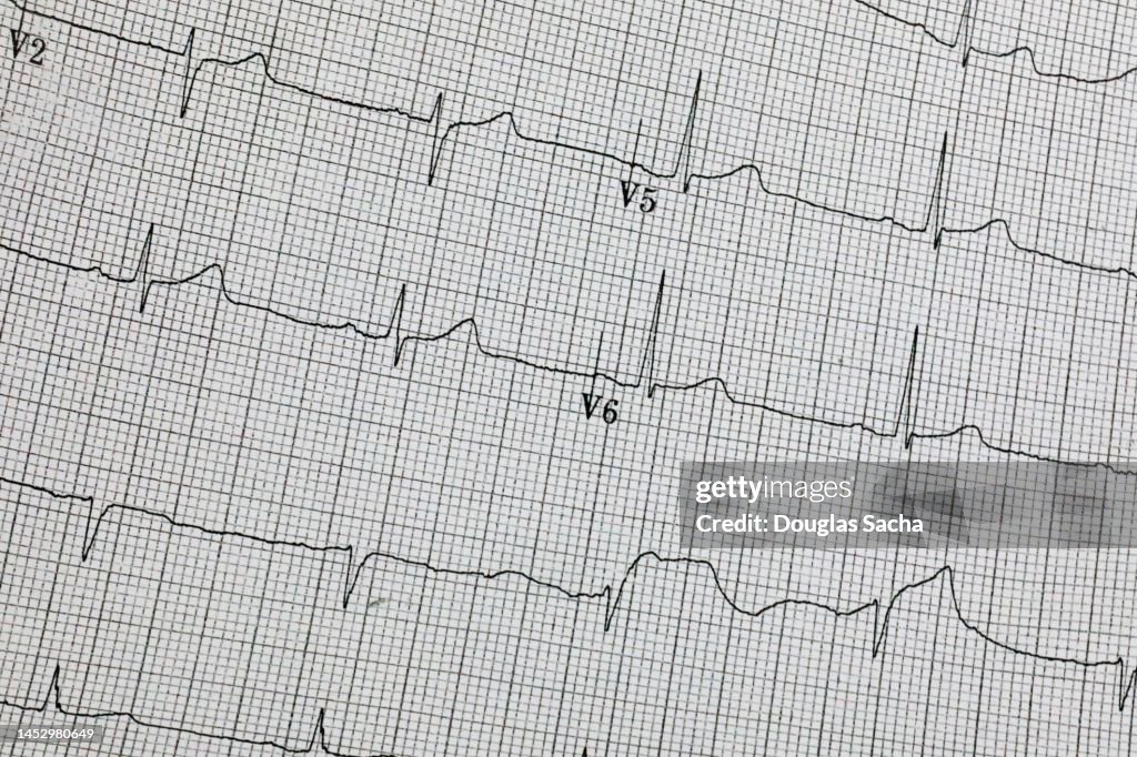 EKG - Electrocardiogram (XXL)