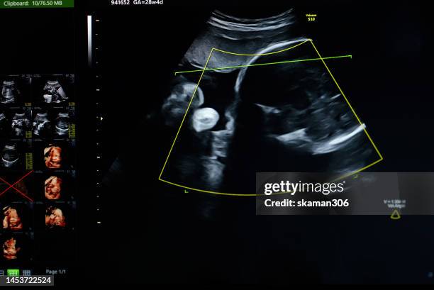 doctor used an ultrasound sonogram  monitor for  the fetus 30 weeks young adult patient pregnant - 20 week foetus stock pictures, royalty-free photos & images