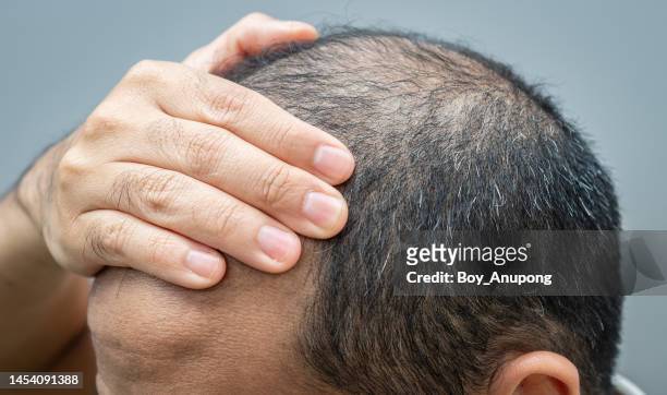 close up of asian man touching his forehead for hiding his baldness. hair loss and gray hair is the sign of aging on men. - hair loss bildbanksfoton och bilder