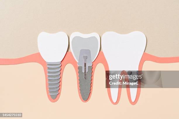 dental implant and its internal structure cross section paper craft - implante dentário - fotografias e filmes do acervo