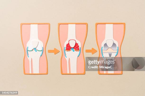 knee joint replacement anatomy diagram paper craft - knieimplantat stock-fotos und bilder
