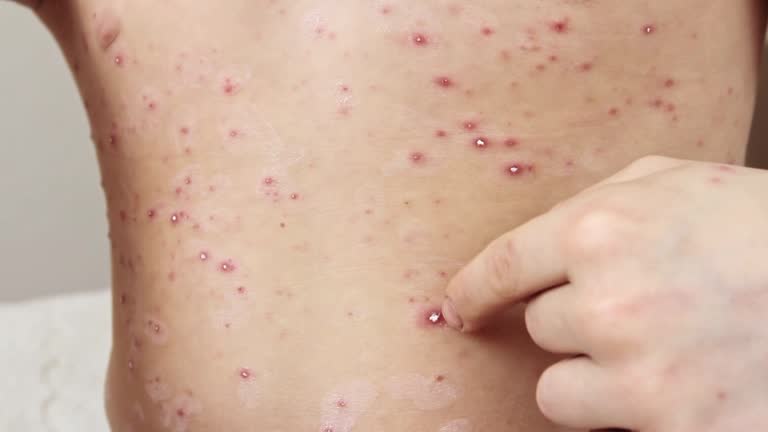 Chicken Food Rash 157 Chicken Pox Rash Stock Videos, Footage, & 4K Video Clips - Getty Images