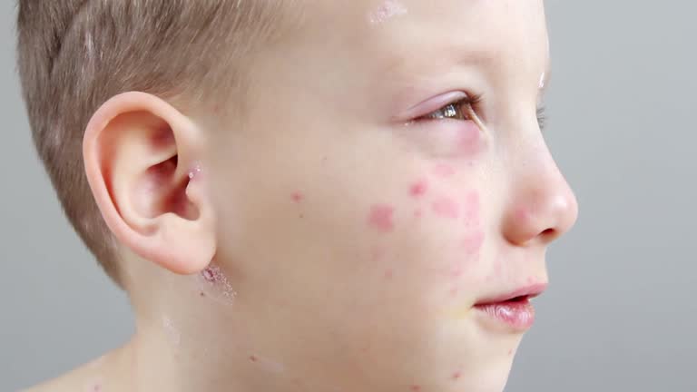 Smallpox In Kids 11 Smallpox Scars Stock Videos, Footage, & 4K Video Clips - Getty Images
