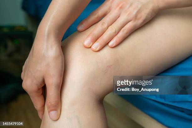 close up of spider veins occur on woman thigh. - krampfadern stock-fotos und bilder