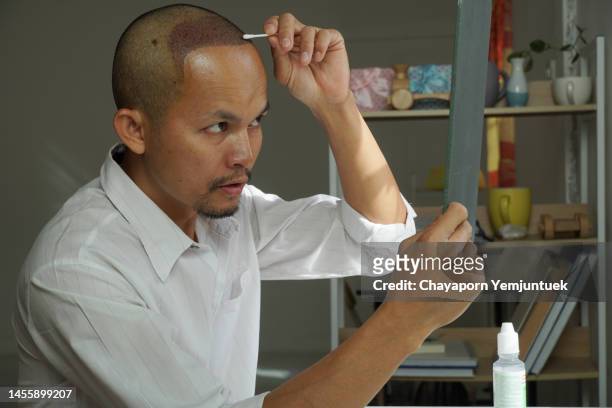 asian men hair transplant. him cleaning a skin head after hair transplant 3 days. - skin graft 個照片及圖片檔