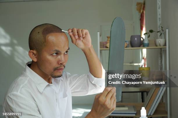 asian men hair transplant. him cleaning a skin head after hair transplant 3 days. - hair growth stock pictures, royalty-free photos & images